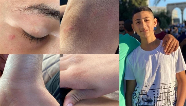 شرطة الاحتلال تعتدي على الطفل المقدسي صهيب أبو ناب بالضرب المبرح