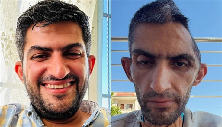 جمجمته تروي العذاب..صورة صادمة لمجاهد بني مفلح بعد خروجه من السجن
